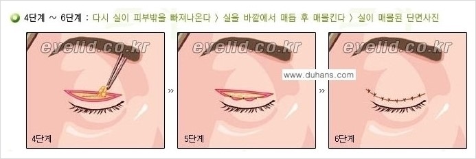 [두한성형외과 경쟁력 눈성형] - [절개법, 매몰법의 수술 방법] 관련 이미지 4