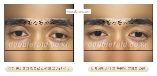 [두한성형외과 경쟁력 눈성형] - [쌍꺼풀 재수술 과정과 쌍꺼풀 재수술 실패의 원인, 쌍꺼풀 재수술의 성공 요건] 관련 이미지 53