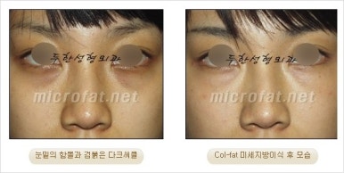 두한성형외과 눈밑수술 - 다크서클 수술 전후 관리 안내 관련 이미지 10
