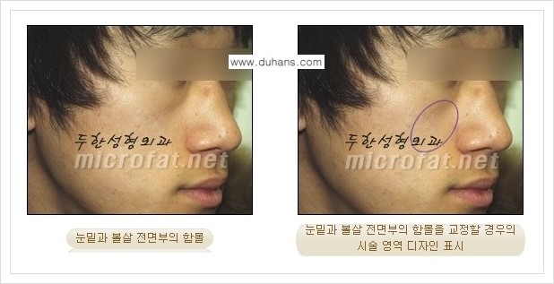 [두한성형외과 경쟁력 미세지방이식] - [귀족수술과 인디언밴드(앞광대주름) 미세지방이식] 관련 이미지 3