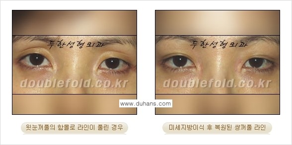[두한성형외과 NO.1 눈성형] - [함몰된(꺼진) 눈꺼풀에서 쌍꺼풀 라인 교정 3.] 관련 이미지 11