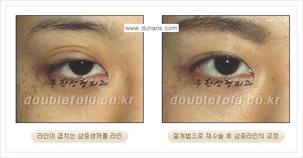 [두한성형외과 경쟁력 쌍꺼풀 재수술, 극한 재수술] - [삼중(세겹) 쌍꺼풀 라인의 교정 안내] 관련 이미지 7