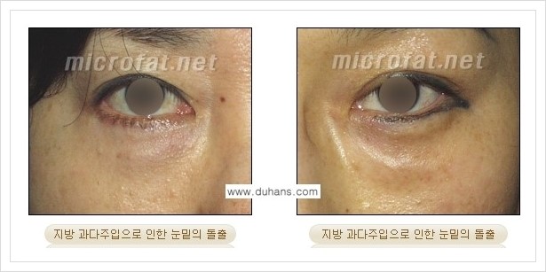 ⁠[두한성형외과 경쟁력 미세지방이식] - [미세지방이식의 부작용 문제 교정 안내] 관련 이미지 5