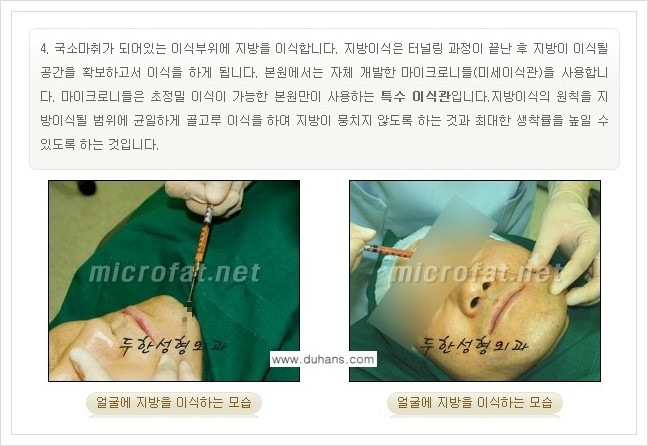 [두한성형외과 경쟁력 미세지방이식] - [타병원에서의 미세지방이식 부작용 교정 방법 안내] 관련 이미지 10
