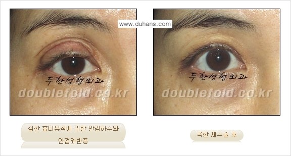 [두한성형외과 경쟁력 쌍꺼풀 재수술, 극한 눈재수술] - [망가진 쌍꺼풀 라인을 교정하는 극한 재수술을  위한 계획] 관련 이미지 6