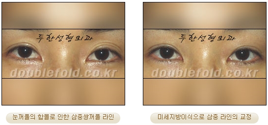 [Eye Reoperation Duhan Plastic Surgery] - [Guide to Double Eyelid Revision Surgery] image 67