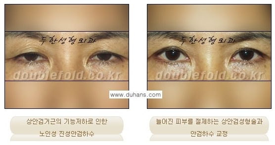 [두한성형외과 경쟁력 눈성형] - [안검하수(졸리운 눈매)의 종류와 교정 방법 안내] 관련 이미지 8