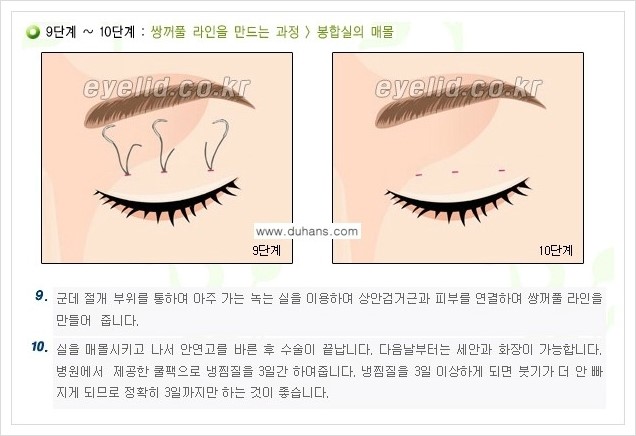 [두한성형외과 경쟁력 눈성형] - [퀵쌍꺼풀 수술] 관련 이미지 6