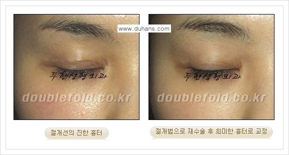 [두한성형외과 경쟁력 쌍꺼풀 재수술, 극한 재수술] - [망가진 눈 복원수술 - 흉터선이 진한 경우 교정 안내] 관련 이미지 6