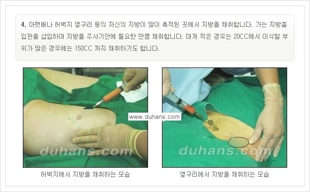 [두한성형외과 경쟁력 미세지방이식] - [부드럽고 아름다운 얼굴선 만들기, 얼굴 미세지방이식 과정 안내] 관련 이미지 3