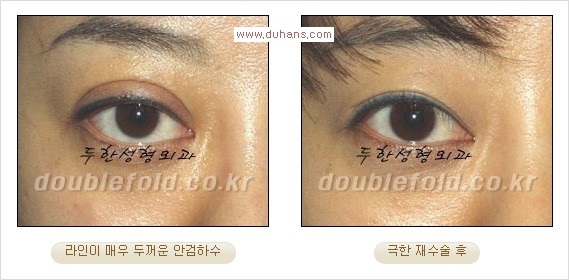 [두한성형외과 경쟁력 쌍꺼풀 재수술] - [피부 여유분이 부족해서 토안증이 발생한 경우 극한 재수술] 관련 이미지 9