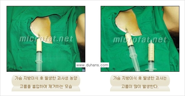 [두한성형외과 경쟁력 미세지방이식] - [타병원의 지방이식 부작용 교정을 위한 마이크로 흡입술 안내] 관련 이미지 5