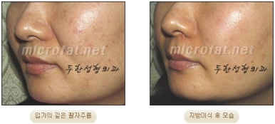 [Duhan Plastic Surgery Face Fat Grafting] - [Reducing Mouth Corners Wrinkles and Nasolabial Folds] image 9