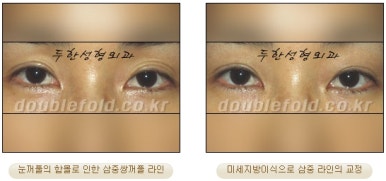눈성형잘하는곳 두한성형외과 - 겹쌍꺼풀 관련 이미지 34
