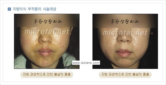 ⁠[두한성형외과 경쟁력 미세지방이식] - [미세지방이식의 부작용 문제 교정 안내] 관련 이미지 3