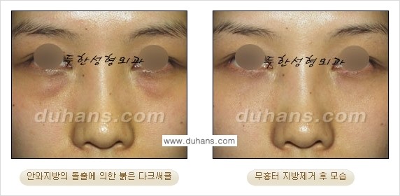 [두한성형외과 경쟁력 지방제거, 지방재배치] - [상큼하고 젊은 눈매 만들기 안내] 관련 이미지 22