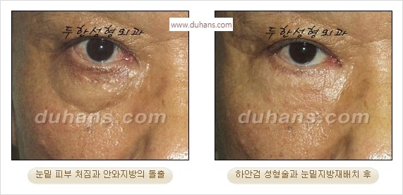 [두한성형외과 경쟁력 안검성형] - [젊어 보이면서 개선된 인상을 주기 위한 성형] 관련 이미지 32