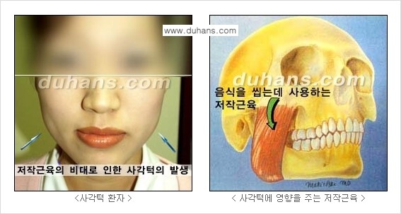 [두한성형외과 각진 얼굴을 갸름한 얼굴형으로의 변신] - [사각턱 보톡스] 관련 이미지 4