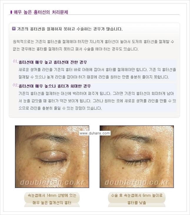 [두한성형외과 경쟁력 쌍꺼풀 재수술, 극한 재수술] - [재수술에서 극복해야 할 극한의 상황과 문제들 안내] 관련 이미지 1