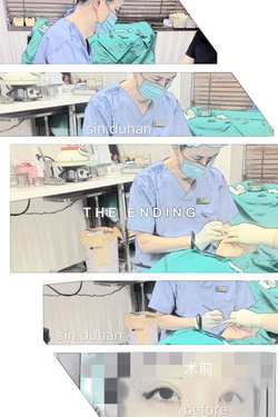 [Duhan Plastic Surgery Eye Surgery] - [Double Eyelid Scar, Double Eyelid Scar Tissue, Revision Surgery for Pigeon Eyes and Ptosis Correction] image 42