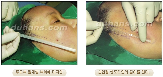 두한성형외과 안티에이징 리프팅 - 엔도타인 리프팅 관련 이미지 10