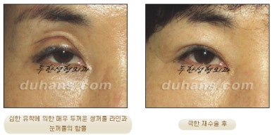[Special Double Eyelid Revision Surgery at Duhan Plastic Surgery] - [Restorative Surgery for Damaged Double Eyelid Eye Shape] image 3