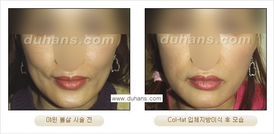 [두한성형외과 경쟁력 미세지방이식] - [탄력있는 피부와 윤곽을 만들어주는 Col-fat 지방이식] 관련 이미지 18