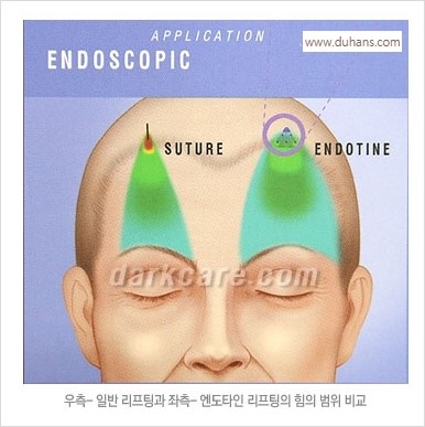 [두한성형외과 경쟁력 주름성형] - [주름제거와 볼륨을 갖게하는 엔도타인 리프팅] 관련 이미지 17