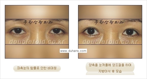 [두한성형외과 경쟁력 눈성형] - [미세지방이식으로 비대칭 쌍꺼풀 라인의 교정 방법 안내] 관련 이미지 4