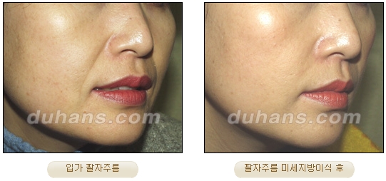 [Duhan Plastic Surgery Facial Autologous Fat Grafting] - [Fat Grafting Guide] image 11