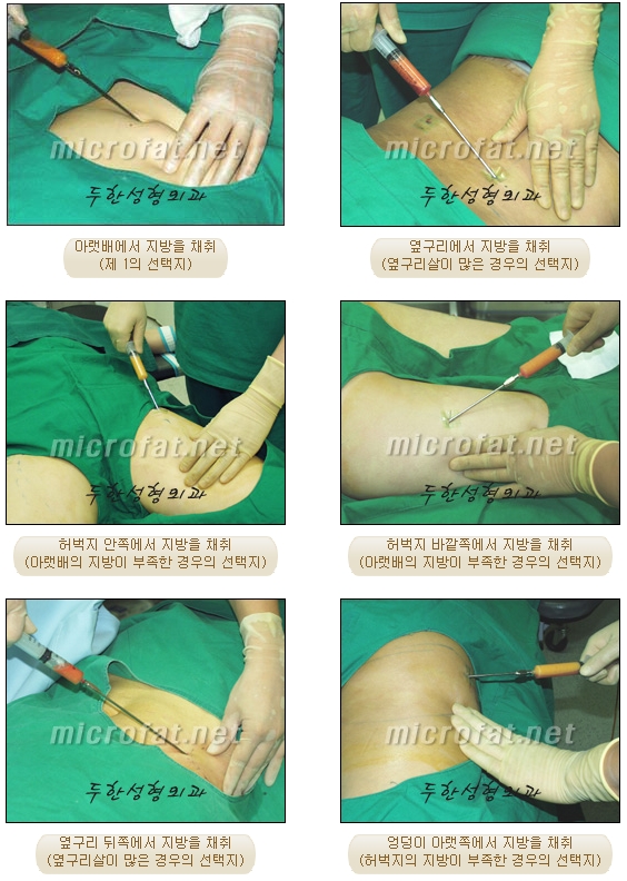 [Duhan Plastic Surgery Double Eyelid Revision Surgery] - [Correcting the Double Eyelid Line in Sunken Eyelids] image 54