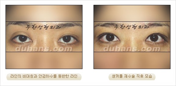 [두한성형외과 경쟁력 눈성형] - [쌍꺼풀 재수술 과정과 쌍꺼풀 재수술 실패의 원인, 쌍꺼풀 재수술의 성공 요건] 관련 이미지 86