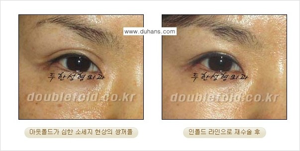 [두한성형외과 쌍꺼풀 재수술] - [지나친 아웃폴드 라인의 쌍꺼풀 재수술] 관련 이미지 3