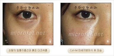 두한성형외과 눈밑수술 - 다크서클 수술 전후 관리 안내 관련 이미지 32