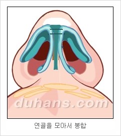 DuHan Plastic Surgery Revision Rhinoplasty - AlloDerm Nose Surgery, SureDerm Nose Surgery image 10