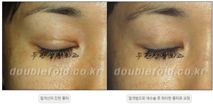 [Double Eyelid Surgery Duhan Plastic Surgery] - [Revision Methods] image 42