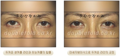 [두한성형외과 쌍커풀수술] - [쌍꺼풀지방이식] 관련 이미지 11