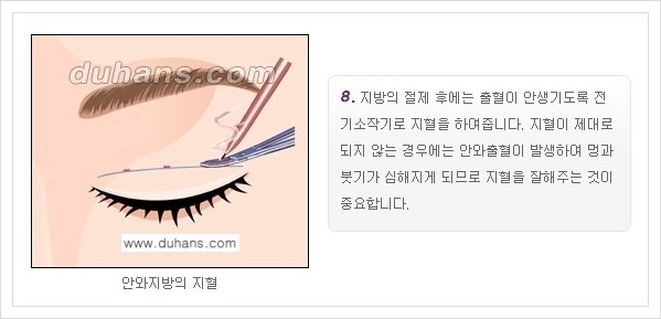 [두한성형외과 경쟁력 눈성형] - [퀵쌍꺼풀 안내] 관련 이미지 9