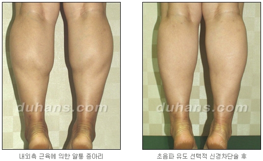 [Duhan Plastic Surgery Calf Reduction] - [How to Get Rid of Calf Muscle Bulges] image 23