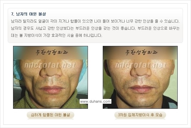 [두한성형외과 경쟁력 볼살지방이식] - [사각턱의 경우, 측면 볼살의 함몰선, 안면비대칭, 남성 야윈볼살 안내] 관련 이미지 12