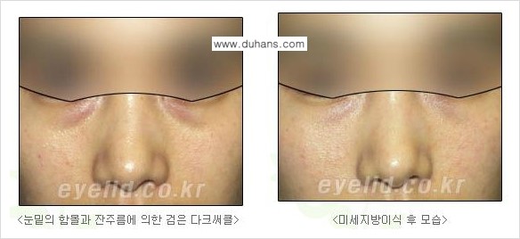 ​[두한성형외과 다크써클 치료] - [눈밑에 돌출이 있으면서 그 아래 함몰주름선이 있는 다크써클 증상] 관련 이미지 4