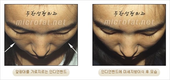 [두한성형외과 경쟁력 지방이식 리더] - [Col-fat(콜펫)지방이식, 3차원 입체지방이식, 2차원 평면지방이식] 관련 이미지 45