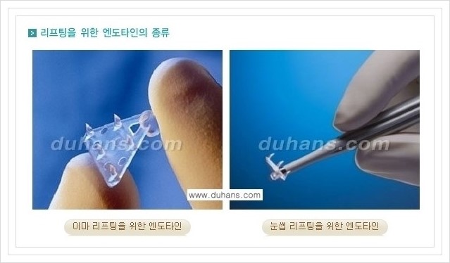 [두한성형외과 경쟁력 주름성형] - [회복과 일상으로의 복귀가 빠른 눈썹거상, 이마주름 엔도타인 리프팅] 관련 이미지 5