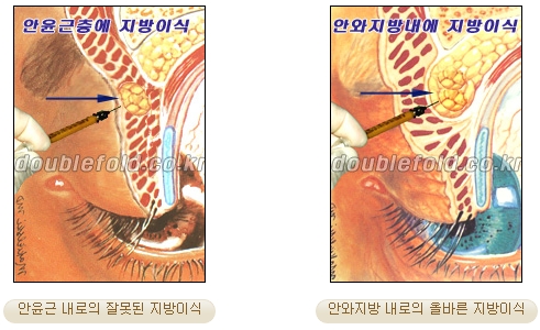 [두한성형외과 쌍커풀수술] - [쌍꺼풀지방이식] 관련 이미지 7