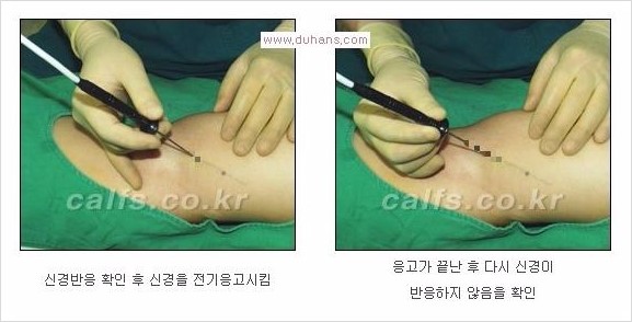 [두한성형외과 Dr. 컬럼 - 타 병원의 종아리 퇴축술 이후 문제가 발생한 경우] 관련 이미지 10