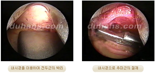 두한성형외과 안티에이징 리프팅 - 엔도타인 리프팅 관련 이미지 25