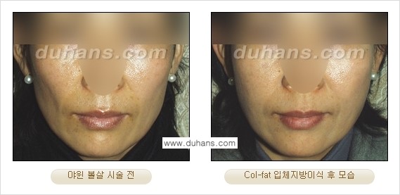 [두한성형외과 경쟁력 미세지방이식] - [탄력있는 피부와 윤곽을 만들어주는 Col-fat 지방이식] 관련 이미지 19