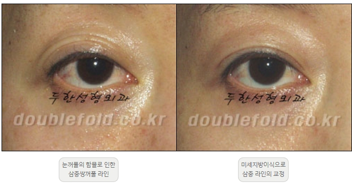 [Double Eyelid Surgery Duhan Plastic Surgery] - [Revision Methods] image 30