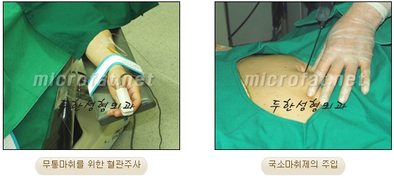 두한성형외과 지방흡입 - 부위별 안전 지방흡입 관련 이미지 8