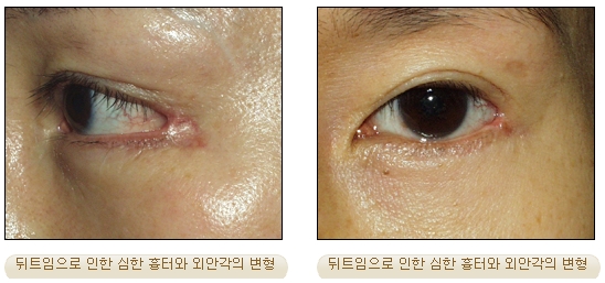 [Duhan Plastic Surgery Double Eyelid Revision] - [Inner Corner Revision, Outer Corner Revision] image 6